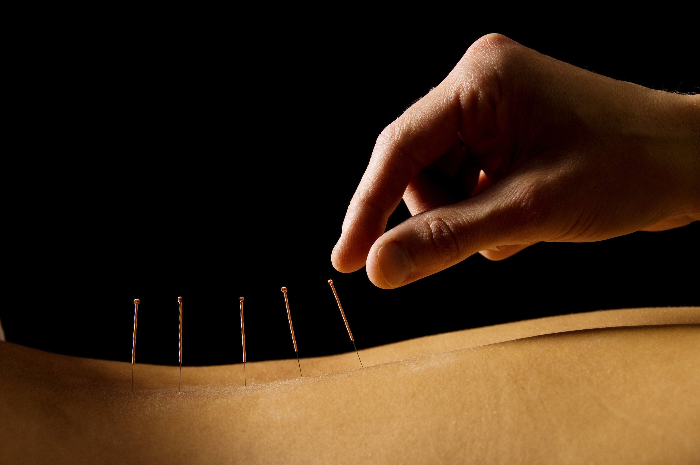 is acupuncture FSA eligible